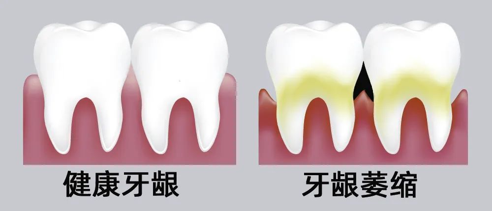 牙縫大露出“黑三角”，既塞牙又難看！還能恢復(fù)嗎？